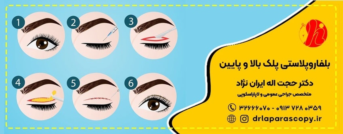 Who is the best plastic eye surgeon in Isfahan?