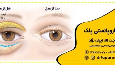 Who is the best plastic eye surgeon in Isfahan?