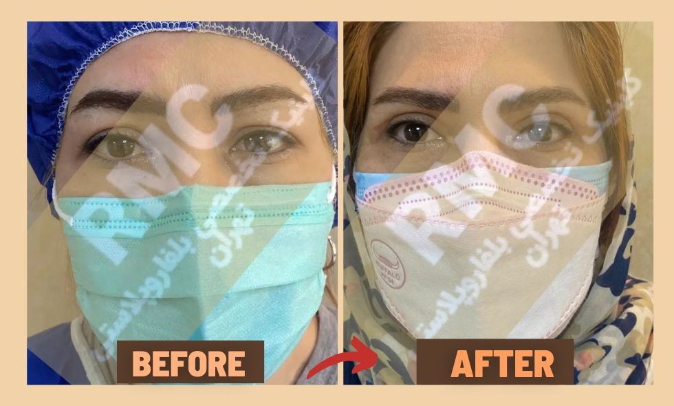 Eyelid surgery clinic in Tehran